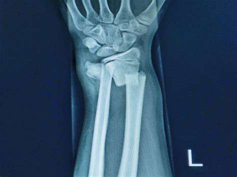 ManagingBrokenBones:ImmobilizationisCrucial